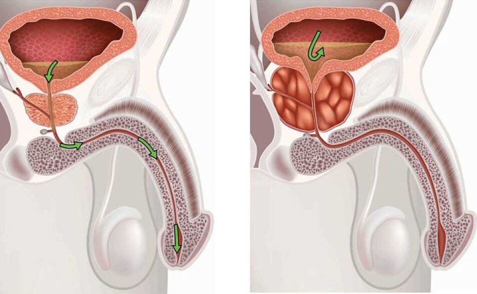 Panghubag sa glandula sa prostate
