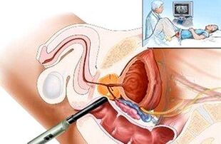 Mga paagi sa pagdayagnos sa prostatitis