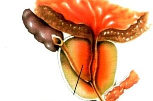 Unsa ang prostatitis sa mga lalaki