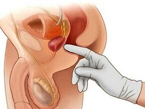 Prostate Massage alang sa pagtambal sa mga prostatitis sa mga lalaki