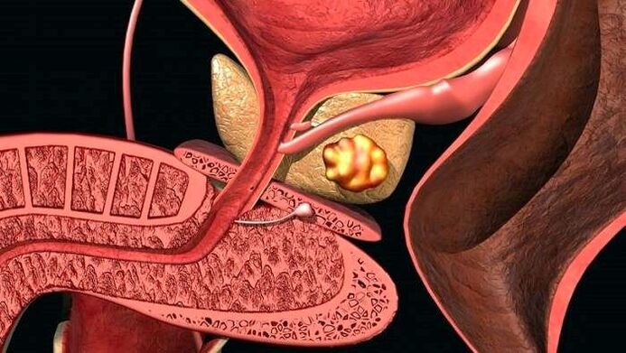 Mga deposito sa bato sa prostate nga adunay calculous prostatitis