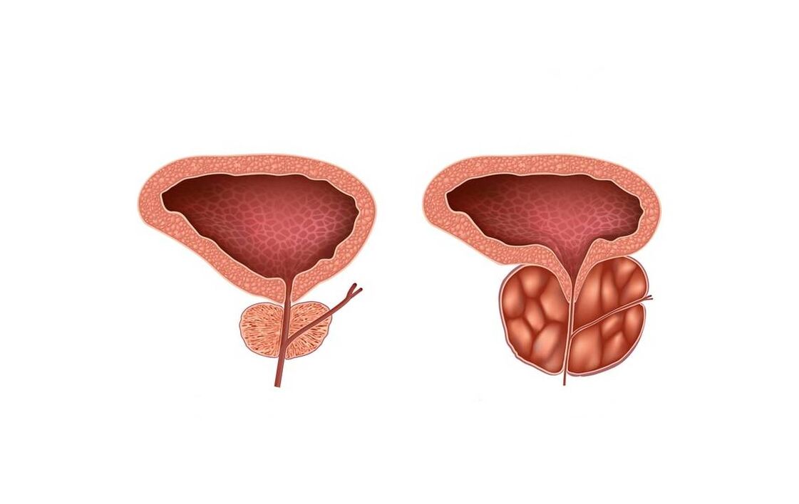 Sintomas sa prostatitis sa mga lalaki