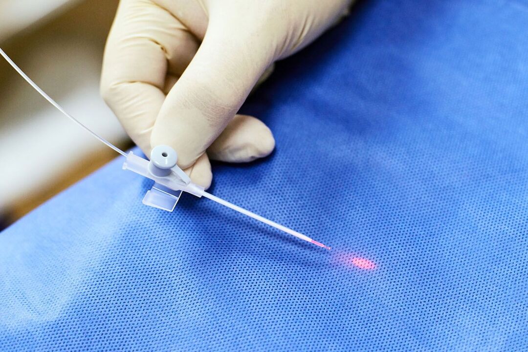 transrectal device alang sa prostate treatment