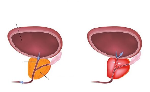 normal ug inflamed prostate