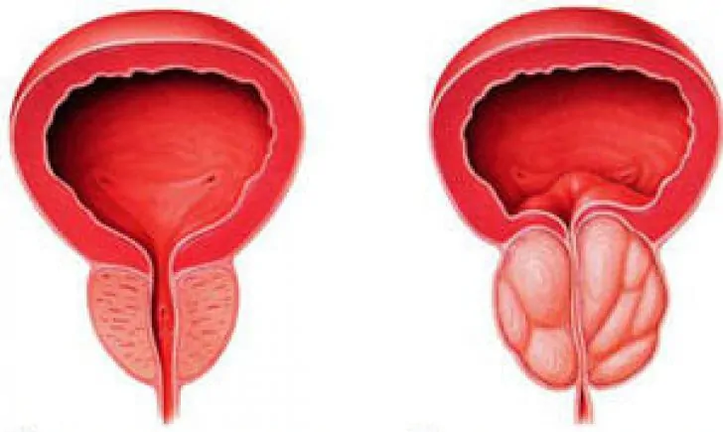 Normal nga prostate (wala) ug inflamed chronic prostatitis (tuo)